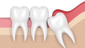 pericoronitis