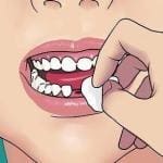 bleeding after tooth extraction