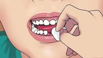 bleeding after tooth extraction