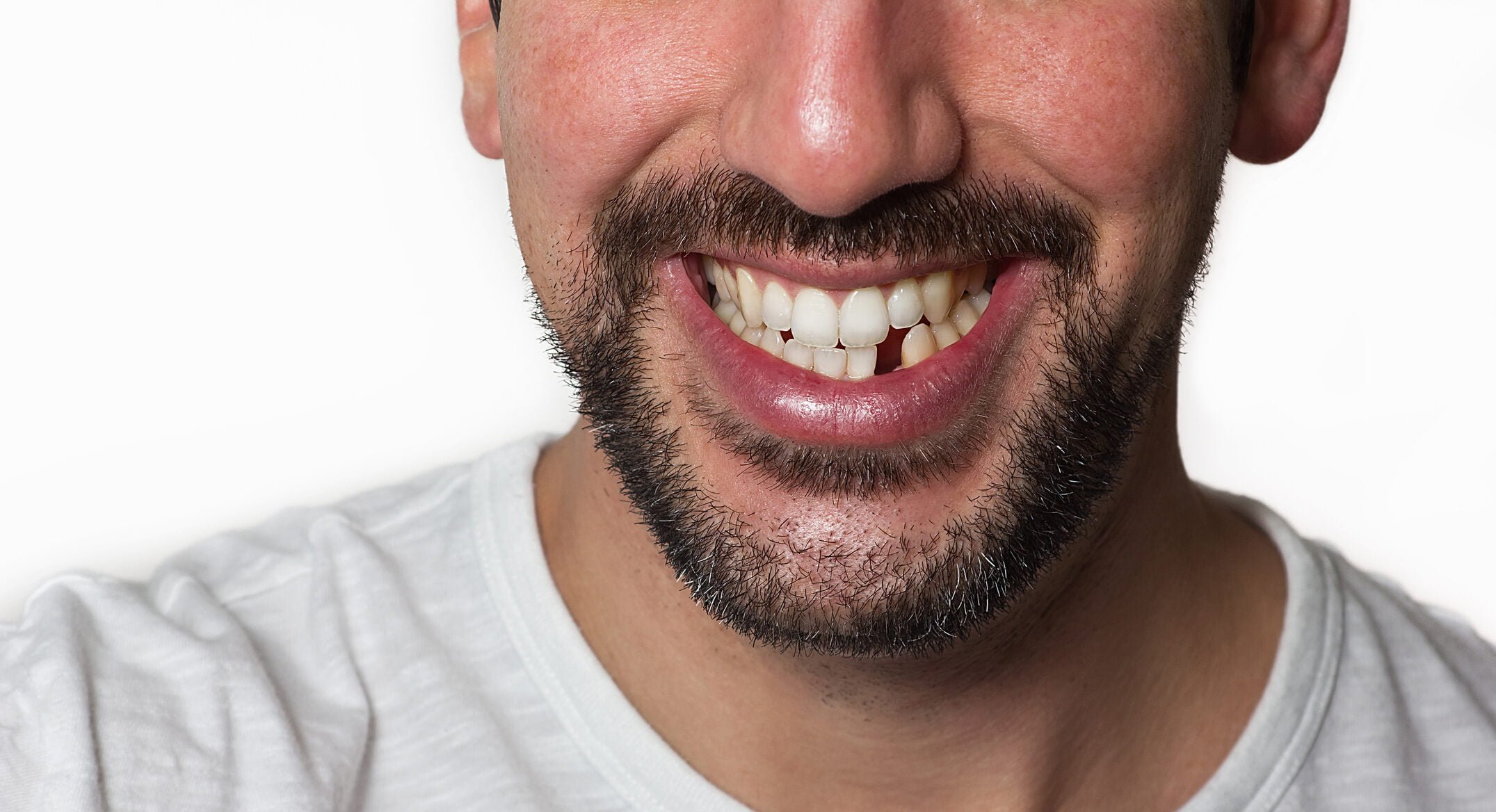 Missing Teeth Exploring the Causes and Impact on Oral Health