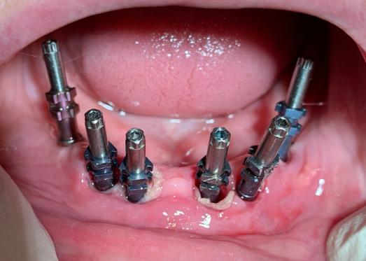 How many dental implant we need to reconstruct a full arch?