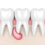 dental cysts