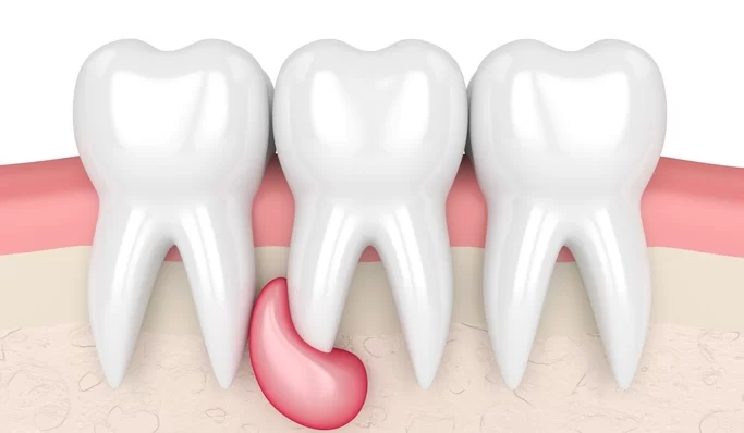 dental cysts