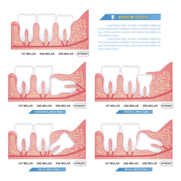 types of wisdom tooth impaction