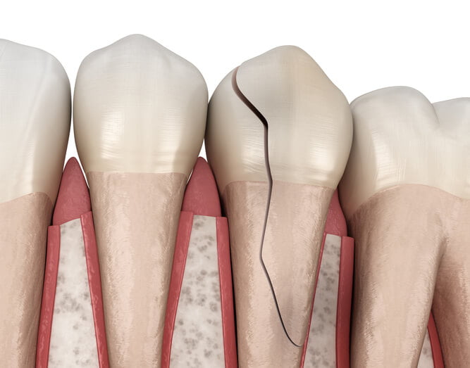 Types of Tooth Fracture