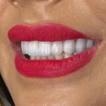 ceramic veneers