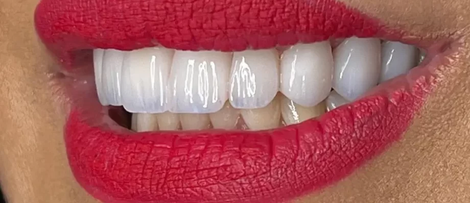 ceramic veneers