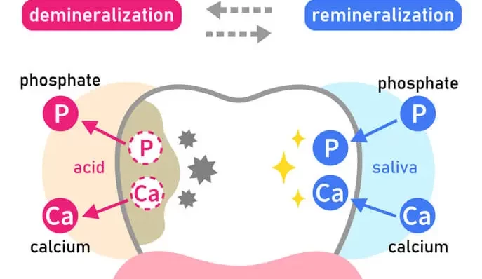 remineralization