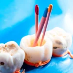 root canal filling materials