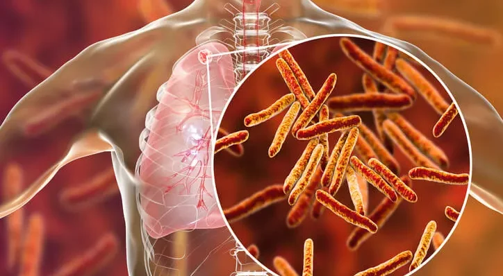 tuberculosis in dentistry