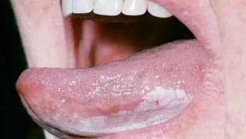 Leukoplakia