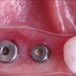 Soft Tissue Augmentation Around Dental Implants