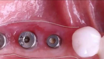 Soft Tissue Augmentation Around Dental Implants