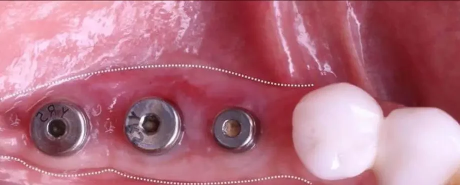 Soft Tissue Augmentation Around Dental Implants