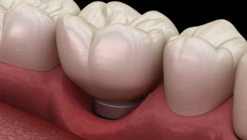 Soft Tissue Management Around Dental Implants