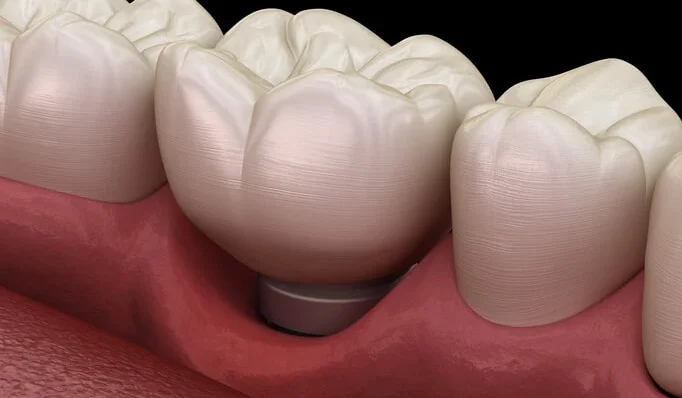 Soft Tissue Management Around Dental Implants