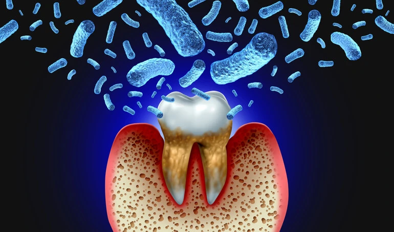 Trench Mouth: Understanding, Causes, Symptoms, and Treatment