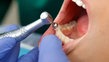 dental polishing