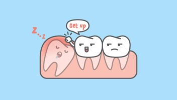 impacted teeth