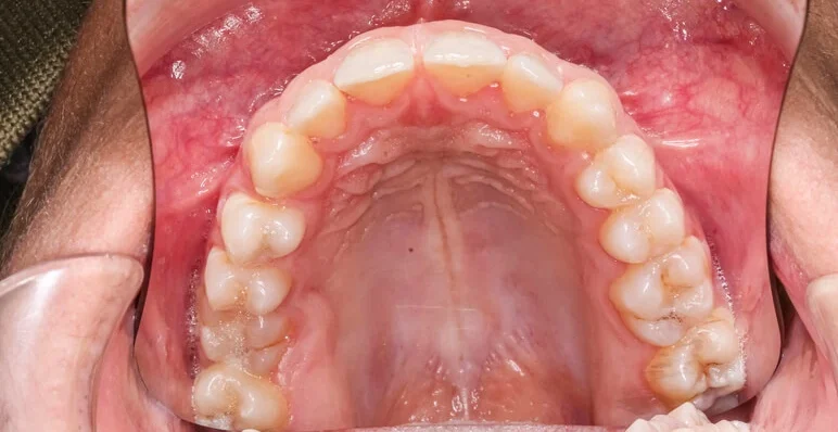 Unveiling Palate Complexity: Deciphering the Roof of the Mouth