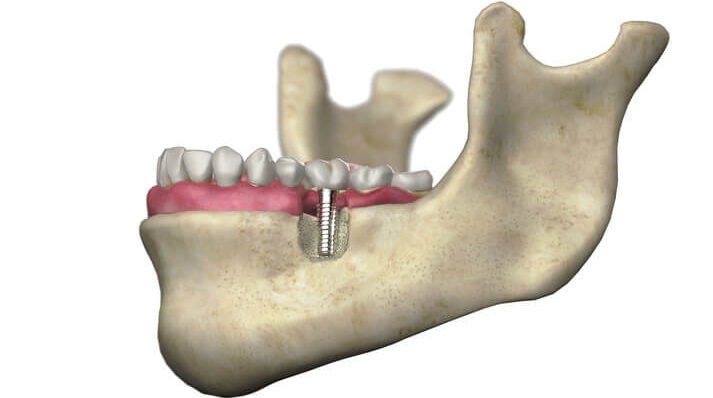 osteonecrosis of the jaw