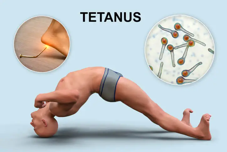 Clinical Presentation of tetanus