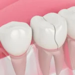 broken dental crown