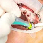 surgical guides for dental implants