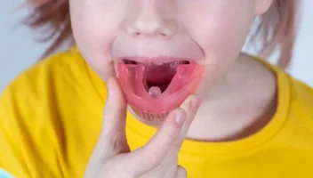 tongue thrusting treatment