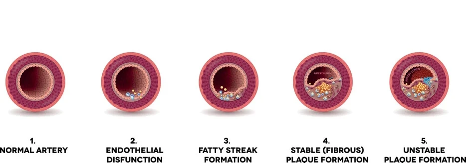 atherosclerosis formation