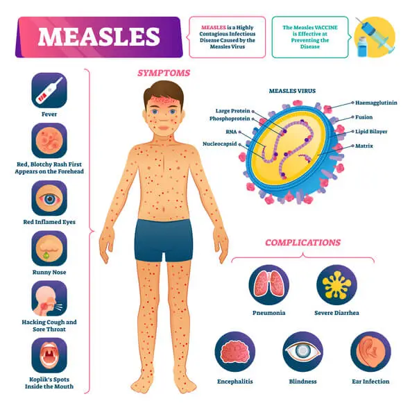 measles symptoms and complications