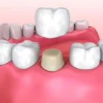 Choice of Cement for Single-Unit Crowns