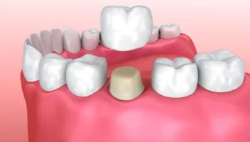 Choice of Cement for Single-Unit Crowns