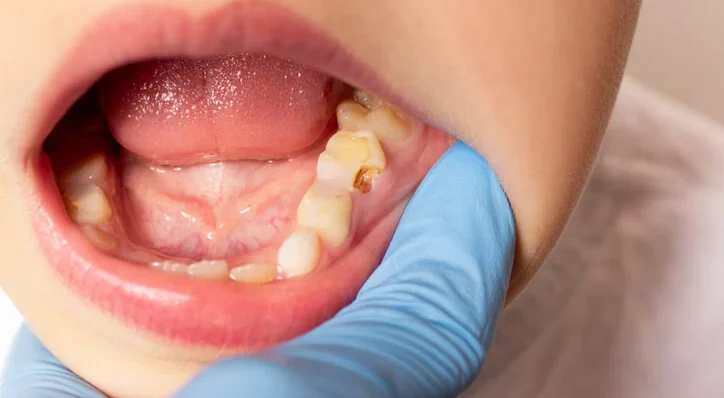 carious lesions in primary teeth