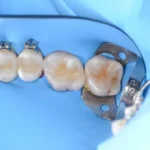 composite restoration of posterior tooth