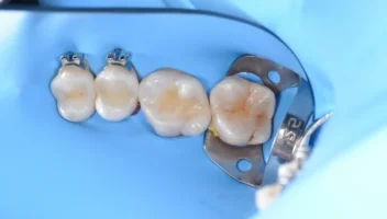 composite restoration of posterior tooth