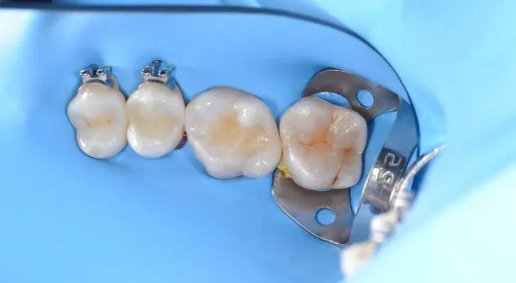 composite restoration of posterior tooth