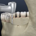 flapless implant surgery