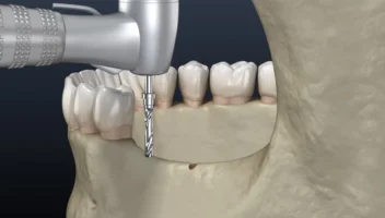 flapless implant surgery