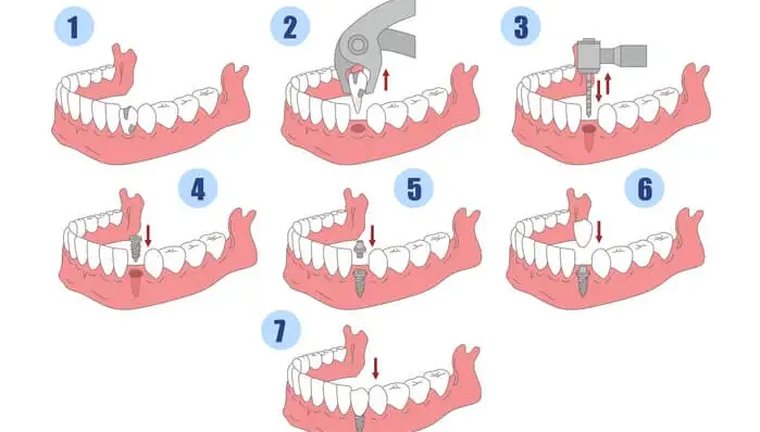 fresh socket implant