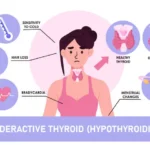 hypothyroidism