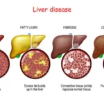 liver diseases