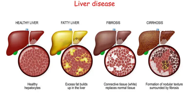 liver diseases