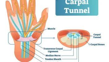 carpal tunnel syndrome