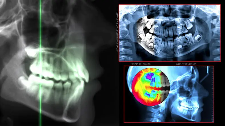 Cephalometric Radiograph and Analysis