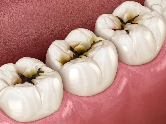 dental caries