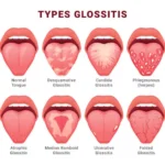 glossitis