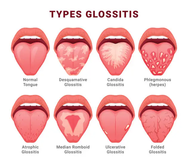 glossitis