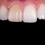 internal tooth whitening