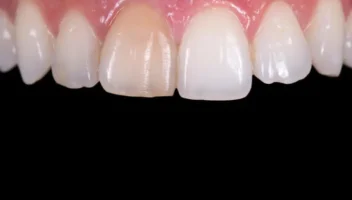 internal tooth whitening